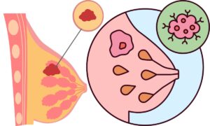 World Breast Cancer Research Day